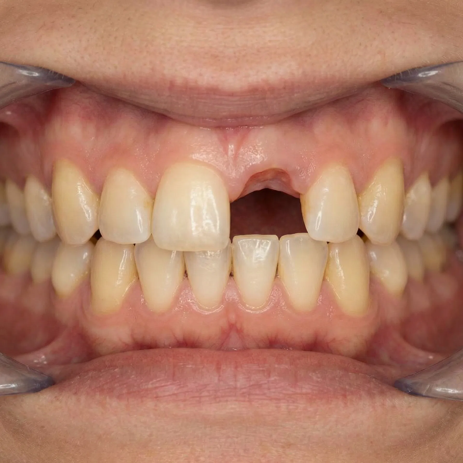 Before Dental Implant Restoration